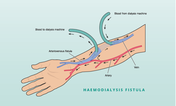 Dialysis Access Sharmila Balanathan Vascular